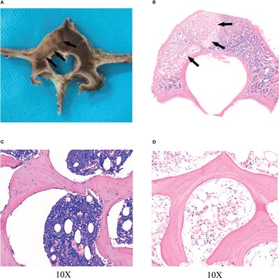 Direct and indirect damage zone of radiofrequency ablation in porcine lumbar vertebra